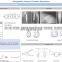 TiNi Shape Memory Alloy Bone Fixation Implant