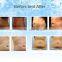 2014 New Slim Freezer Weight Loss Body Reshape / Fat Freeze Belt/cryolipolysis Fat Freezing Machine Loss Weight