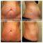 cellulite reduction lipo laser machine/weight loss products best lipo laser machine