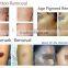 1064 And 532nm Tattoo Naevus Of Ito Removal Removal Q-switched Nd Yag Laser Q Switched Laser Machine