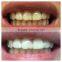 teeth whitening retractor teeth whitening kits for dentists