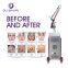 Hot sale New Nd Yag Laser Tattoo Removal  Laser Pigmentation Removal Dark Spot Remove Beauty Machine