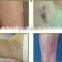 Distributor wanted Smart 808nm diode laser hair removal machines for sale