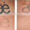 Newest Q switch nd yag laser for tattoo removal/salon beauty tattoo q switched nd yag laser
