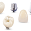 Custom abutments are available in titanium and zirconia