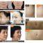 Professional microneedle fractional rf system skin rejuvenation RF acne scar warts removal machine
