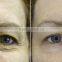 Skin Rejuvenation Wrinkle Removal RF Fractional Microneedle