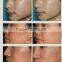 2016 micro needle rf / fractional rf microneedle /radio frequency rf for wrinkle removal and skin rejuvenation