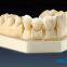 Wieland Zenostar dental crown, solid zirconia bruxzir, dental teeth, laboratoire dentaire, Dentallabor, laboratorio dental, dental laboratory, Shenzhen LJ dental lab China