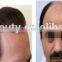 Beauty Salon Laser Hair Regrowth Machine for Hair Loss Treatment/Best Hair Regrowth Machine