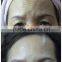 New design hifu face lifting machine SMAS layer lift with amazing instant effect