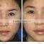 40W Fractional CO2 Laser Acne Scar & Wrinkle Removal / Co2 Laser Surgical Product Vaginal Applicator