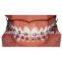 orthodontic metal bracket edgewise roth mbt