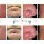 Zhengjia Mecical High Quality Products Vascular Removal, Thread Vein Removal Beauty Machine For Home Use