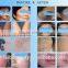 agent and distributor wanted ipl shr Elight yag laser machine for beauty spa clinic and salon