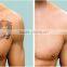 Haemangioma Treatment Q-Switch ND Yag Laser System With Medical CE+laser Tattoo Removal Machine Varicose Veins Treatment