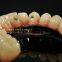 Full-arch Implant Bridge Prosthesis, Implant Denture Framework, Implant Prosthesis, Laboratoire Dentaire, Dentallabor, Laboratorio Dental, Dental Laboratory, Shenzhen LJ Dental Lab China