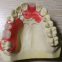 3d print PFM denture & false teeth