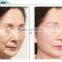 CE Approved Device skin Lifting high intensity focused ultrasound wrinkle removal face lift