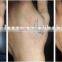 q switched nd yag laser beauty skin care equipment for tattoo removal