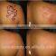 Best Quality Q Switched Nd Yag Laser Tattoo Removal System/laser Tattoo Removal System Age Pigment Freckle Removal/professional Clinic Nd Yag Korea Permanent Tattoo Removal
