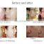 Pdt For Body Pdt Photon Led Light Therapy