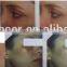 Eye Wrinkle / Bag Removal Fractional Co2 Laser 0.1mj-300mj Stretch Mark Removal Acne Scar Removal Machine Warts Removal