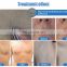 Professional depilation three wave laser hair removal 808nm diode for home use korea laser