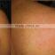 eyebrow removal yag laser tatoo removal treatment1064 nm 532nm nd yag laser onicomicosis med-810a