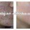Remove Neoplasms Portable Fractional Co2 Laser Co2 Laser /cheapest Co2 Eye Wrinkle / Bag Removal Multifunctional Laser Machine For Engraving And Cutting With CE Skin Regeneration