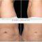 2016 Distributor Wanted Low Price Fat Skin Tightening Freezing Cryolipolysis Vacuum Slimming Beauty Machine Skin Lifting