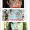 q swith nd yag laser /nd yag laser tatoo removal/q switch laser