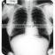 fuji x-ray film diht /mammography x - ray films 14*17in/ agfa dry film 14*17