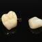 Dental crown zirconia PFZ, dental teeth, dental prosthesis, laboratoire dentaire, Dentallabor, laboratorio dental, dental laboratory, Shenzhen LJ dental lab China