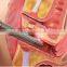 2016 fractional co2 laser acne scar removal with RF power