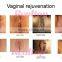 2016 Effective CO2 Fractional Laser Equipment Skin Tightening For Vaginal Tightening Advance Fractional CO2 Laser Warts Removal