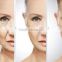 2016 Newest Design Skin Rejuvenation Skin Care HIFU Machine for Face Treatment