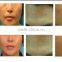 Professional 2 handles / 5 handles micro needle fractional rf wrinkle removal machine with different size tips