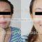 dermabrasion skin rejuvenation peel machine/microdermabrasion peel machine/professional microdermabrasion peel machine