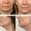 Latest Thermagical Fractional System Thermagie machine  face lift/skin tightening