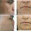 2016 Skin Tightening Home Use RF Anti Wrinkle Home Use Beauty Machine