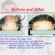 Professional Laser Hair Regrowth Machine/diode Laser/hair Loss/808nm/650nm/hair Regrowth