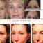 2015 Newest anti wrinkle machine/ skin tightening wrinkle removal machine