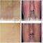 Very excellent effective 30MHz vascular removal spider veins removal for clinic and beauty spa.