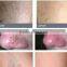newest products 980 nm diode laser vascular removal machine/ blood vessels removal device