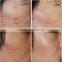 Radio frequency machine rf price / best rf skin tightening face lifting machine wanted