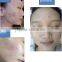 Medical skin care for dermabrasion /comedones water oxygen therapy