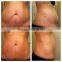 I-lipo Laser Cavitation Machine Body Slimming For Slimming/lipo Slim Machine 1MHz