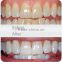 AYJ-J003B DentalTeeth whitening bleaching machine with CE certificate blue light lamp & zoom teeth whitening machine