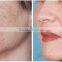 2016 Newst Powerful Ipl+elight+shr 3 in 1 Hair Removal Machine